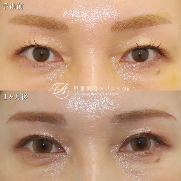 眉下切開 症例写真 | 自然な目元へ
