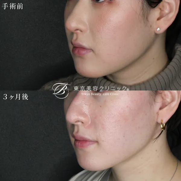 フェイスリフト症例写真：術後3ヶ月